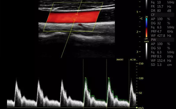 飞依诺超声扫查图像