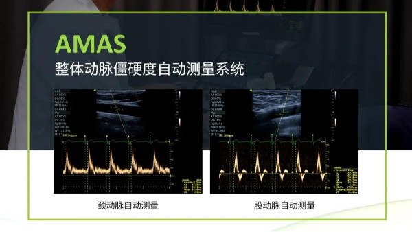 飞依诺AMAS系统：心脑血管疾病的超级预言家！