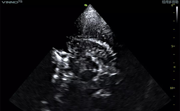 飞依诺经颅超声图像