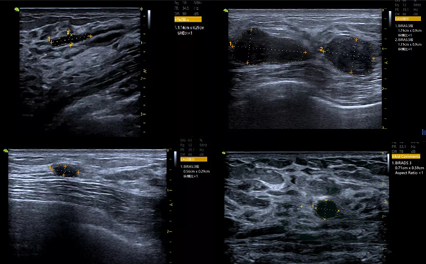 飞依诺彩超VAid乳腺病灶自动检测功能