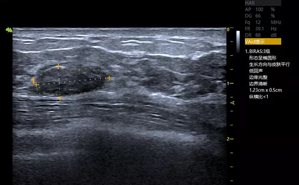 飞依诺彩超VAid乳腺病灶自动检测功能