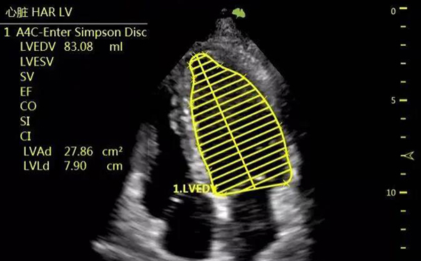 飞依诺彩超Auto EF左心室心功能自动测量