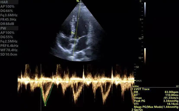 飞依诺彩超LVOT TVI帮助心有效输出量评估