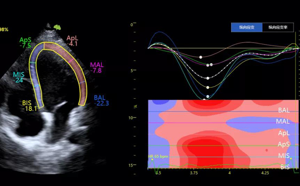 飞依诺彩超心肌应变成像