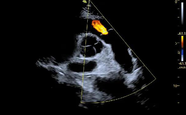 飞依诺彩超肺动脉瓣反流