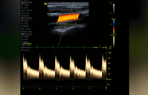 AMAS动脉僵硬度自动测量系统