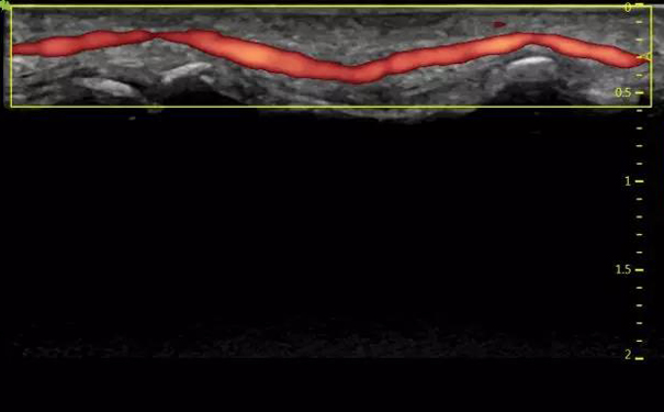 飞依诺超声图像