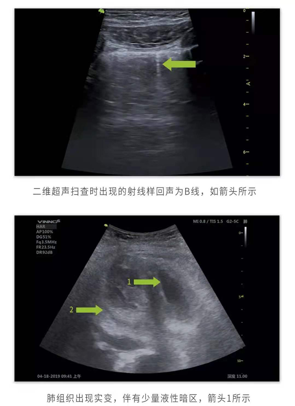 飞依诺便携超声扫查图像