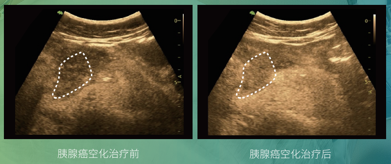 胰腺癌空化治疗