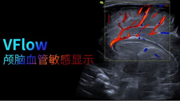 VFLOW分享|新生儿颅内血管的敏感显示