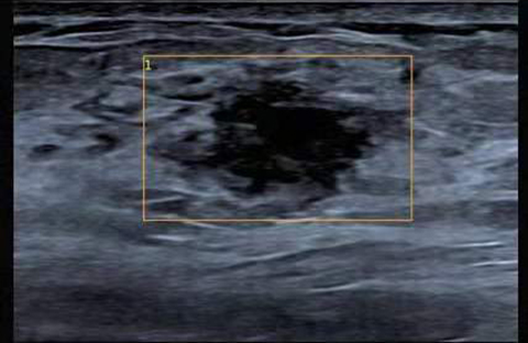 乳腺病灶自动辅助检测VAid