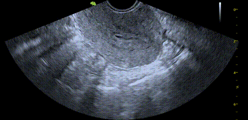 子宫内膜蠕动2