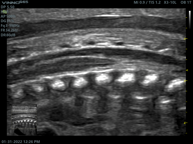 飞依诺超声胎儿脊椎图像