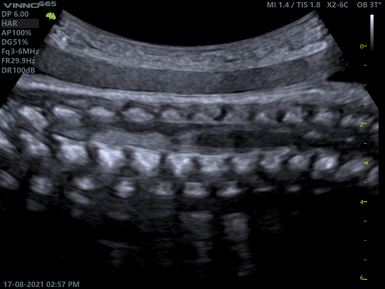 飞依诺超声胎儿脊椎图像