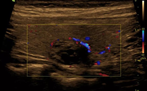 飞依诺彩超清晰显示甲状腺结节血流