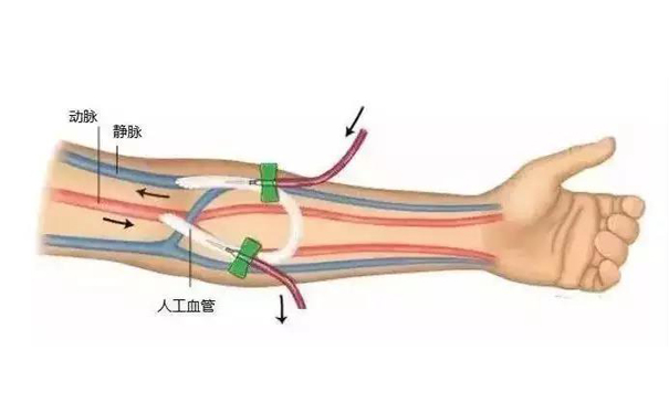 动静脉内瘘