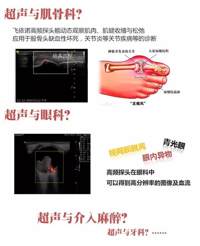 高频探头拓宽超声应用领域