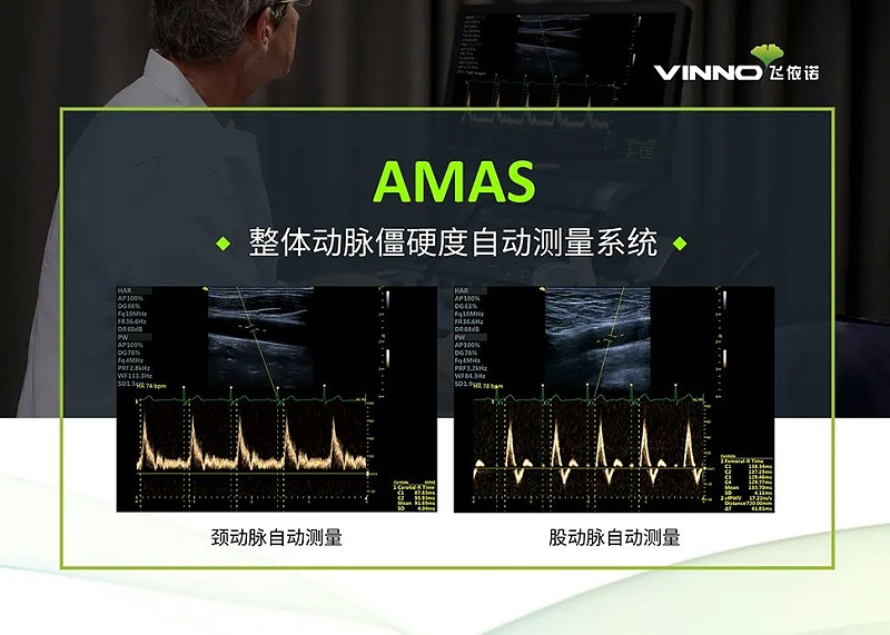 AMAS整体动脉僵硬度自动测量系统
