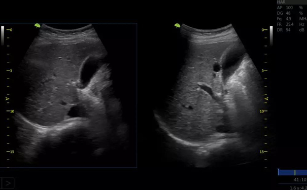 飞依诺超声扫查图像