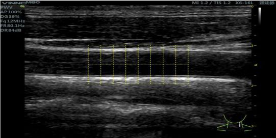 颈动脉局部脉搏波传导速度检测图