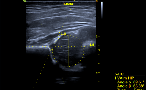 VAim HIP小儿髋关节自动测量