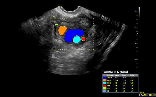 VAim Follicle卵泡自动测量
