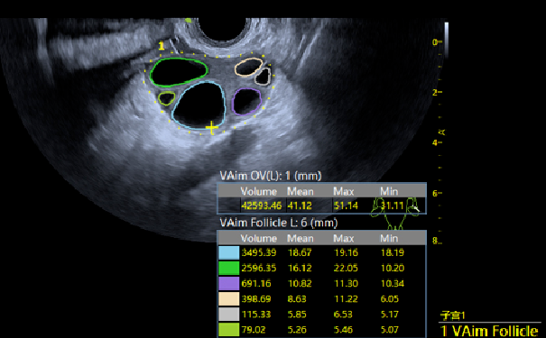 VAim Follicle卵泡自动测量