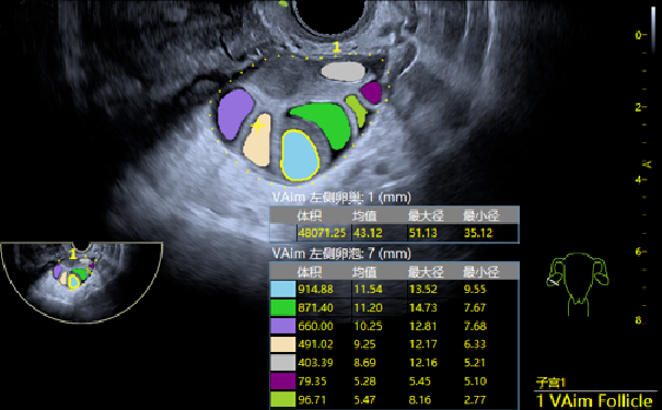 VAim Follicle卵泡自动测量