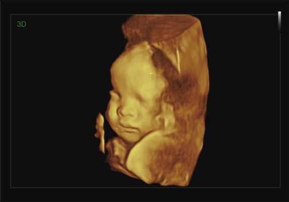 胎儿面部容积成像