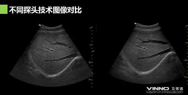 飞依诺彩超图像