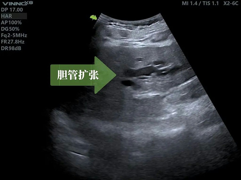 超声引导下PTCD术