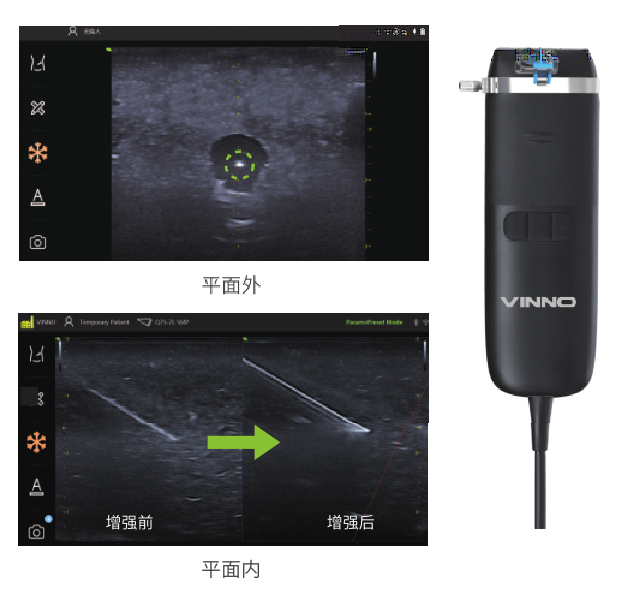 可视化置管，准确穿刺，明察秋毫